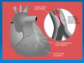 Trombozė ir trombozės rizikos veiksniai 12 puslapis