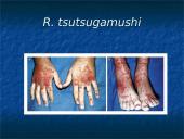 Žmonių riketsiozės 11 puslapis