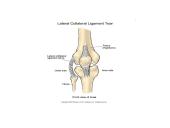 Kineziterapija po kelio sąnario raiščių pažeidimų 17 puslapis