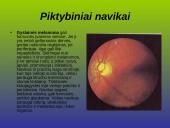 Kraujagyslinio dangalo vystymosi anomalijos ir navikai 16 puslapis