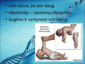 Menkės sindromas 17 puslapis