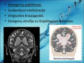 Menkės sindromas 18 puslapis
