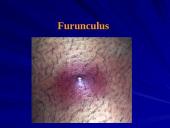 Odos ir minkštųjų audinių infekcija 14 puslapis