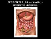 Peritonitas 4 puslapis