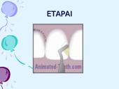 Priekinių dantų padengimas kompozicinėmis plombinėmis medžiagomis 5 puslapis