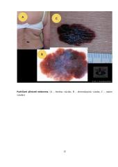Odos vėžys. Melanoma 12 puslapis