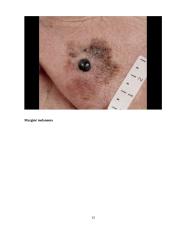 Odos vėžys. Melanoma 13 puslapis