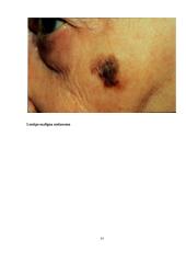 Odos vėžys. Melanoma 14 puslapis