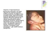 Hipervitaminozė 10 puslapis