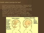 Hidrocefalija 4 puslapis