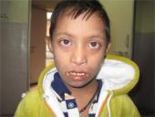 Dauno sindromas skaidrės 8 puslapis