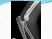 Judėjimo sistemos sutrikimai 14 puslapis