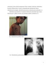 Darbas apie tuberkuliozę, jos sukėlėją, kliniką, diagnostiką 7 puslapis