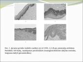 Ligos progresavimas esant gimdos kaklelio intraepiteliniams navikams 11 puslapis