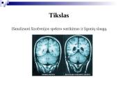 Šizofrenijos spektro sutrikimai, ligonių slauga 2 puslapis