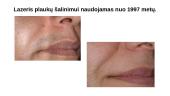 Lazerininė medicina 4 puslapis