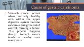 Gastric Carcinoma 4 puslapis