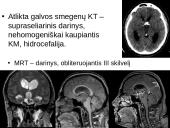 Labai reti galvos smegenų navikai 5 puslapis