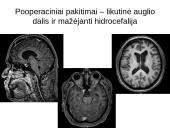 Labai reti galvos smegenų navikai 7 puslapis